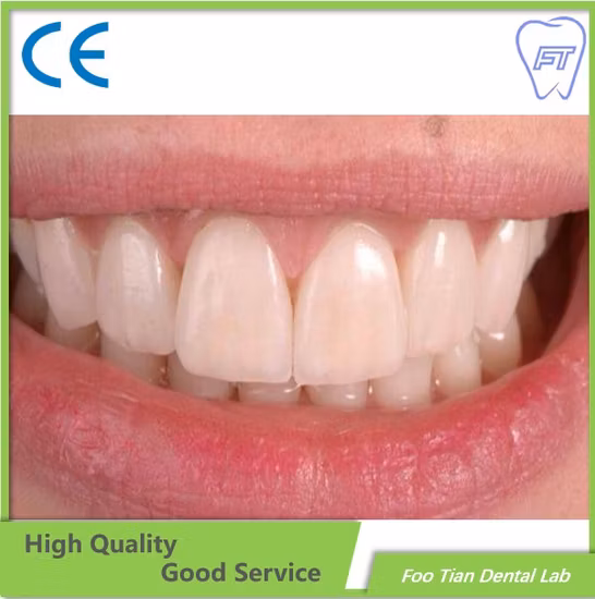 Corona y puente de circonio personalizados fabricados en laboratorio dental de China