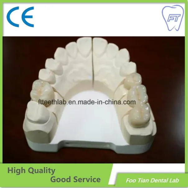 Corona de cerámica de metal dental a precio de fábrica fabricada en el laboratorio dental Foo Tian en Shenzhen, China